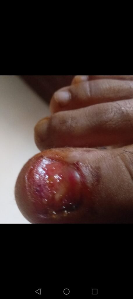 Infected and swollen toe with visible wound needing urgent medical treatment and financial help for recovery.