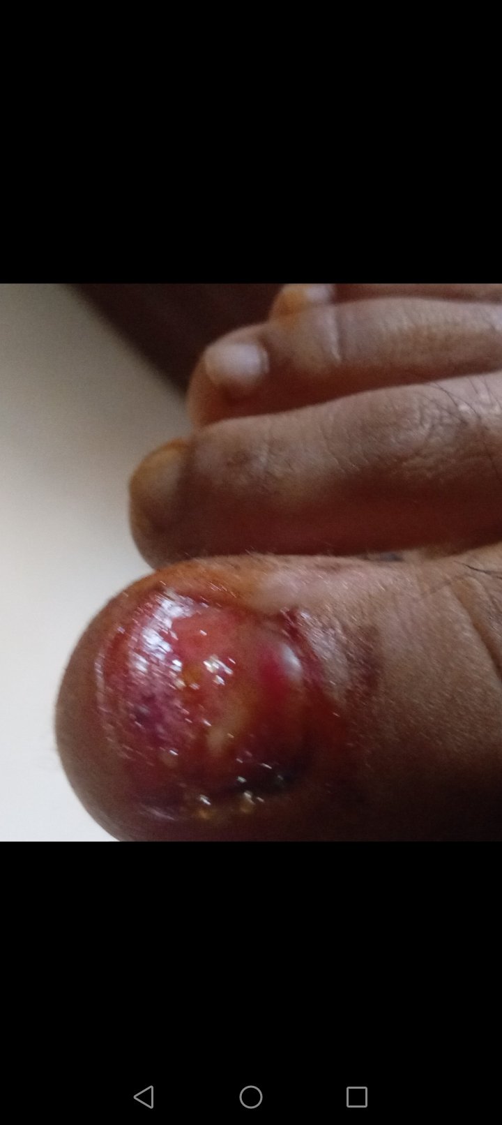 Infected and swollen toe with visible wound needing urgent medical treatment and financial help for recovery.